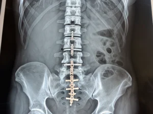 Artrodese de Coluna Minimamente Invasiva